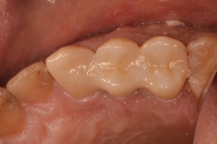 بعد تركيبات اسنان